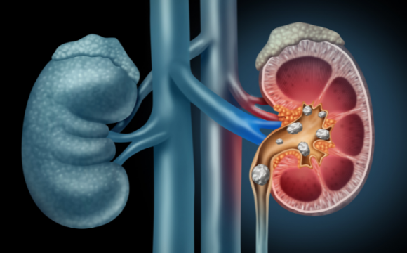 Laser Surgery for kidney Stones