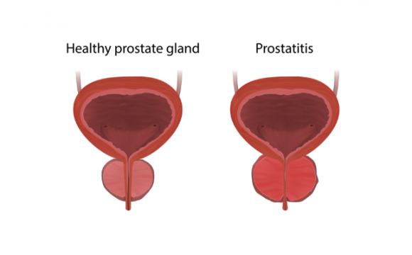 Prostate Gland Enlargement