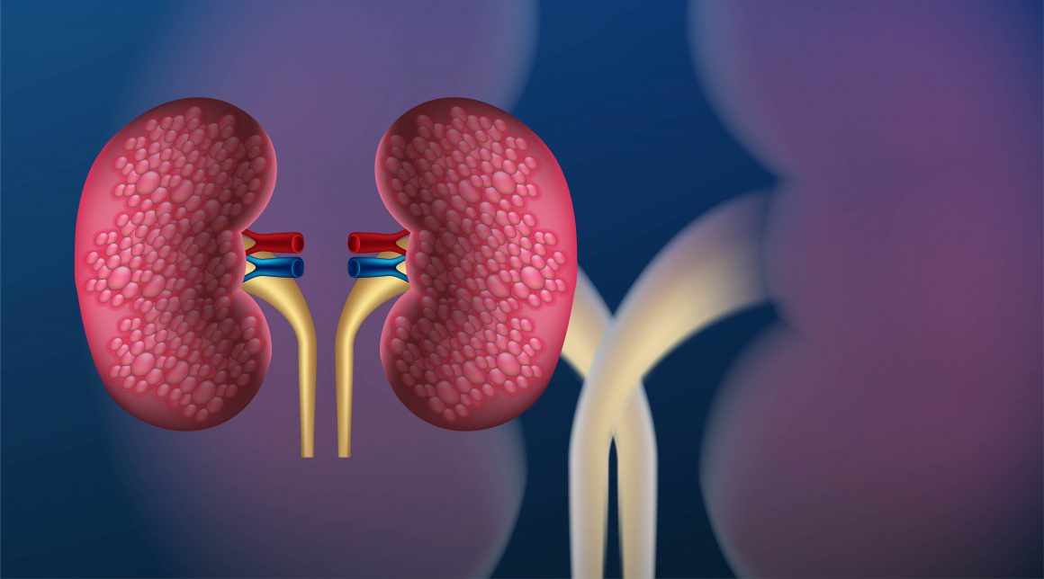 Treatment For Kidney Stones: